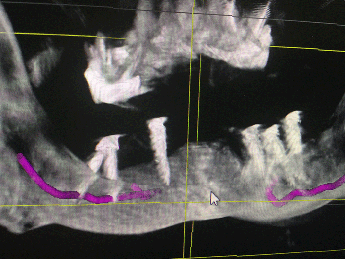 Horrible dental experience in Mexico xray of very bad implants